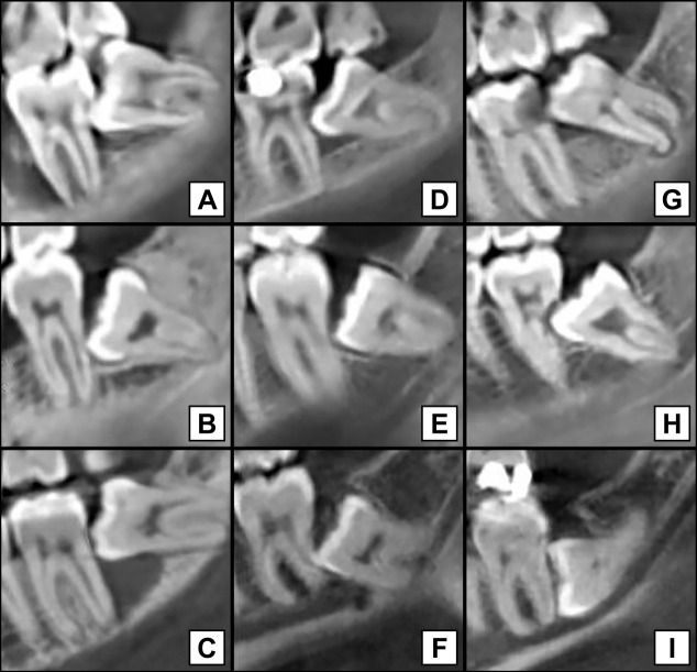 Can the Position of the Impacted Third Molars Be an Early Risk Indicator of Pathological Conditions? A Retrospective Cone-Beam Computed Tomography Study.