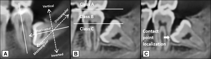 Can the Position of the Impacted Third Molars Be an Early Risk Indicator of Pathological Conditions? A Retrospective Cone-Beam Computed Tomography Study.