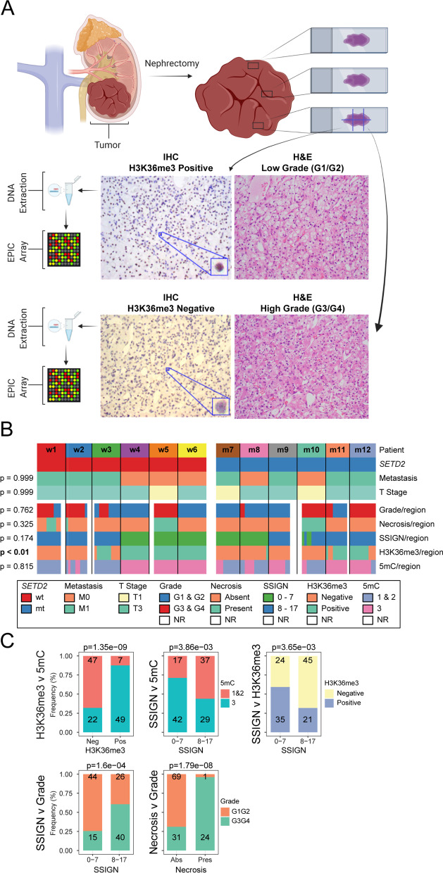 Extensive intratumor regional epigenetic heterogeneity in clear cell renal cell carcinoma targets kidney enhancers and is associated with poor outcome.