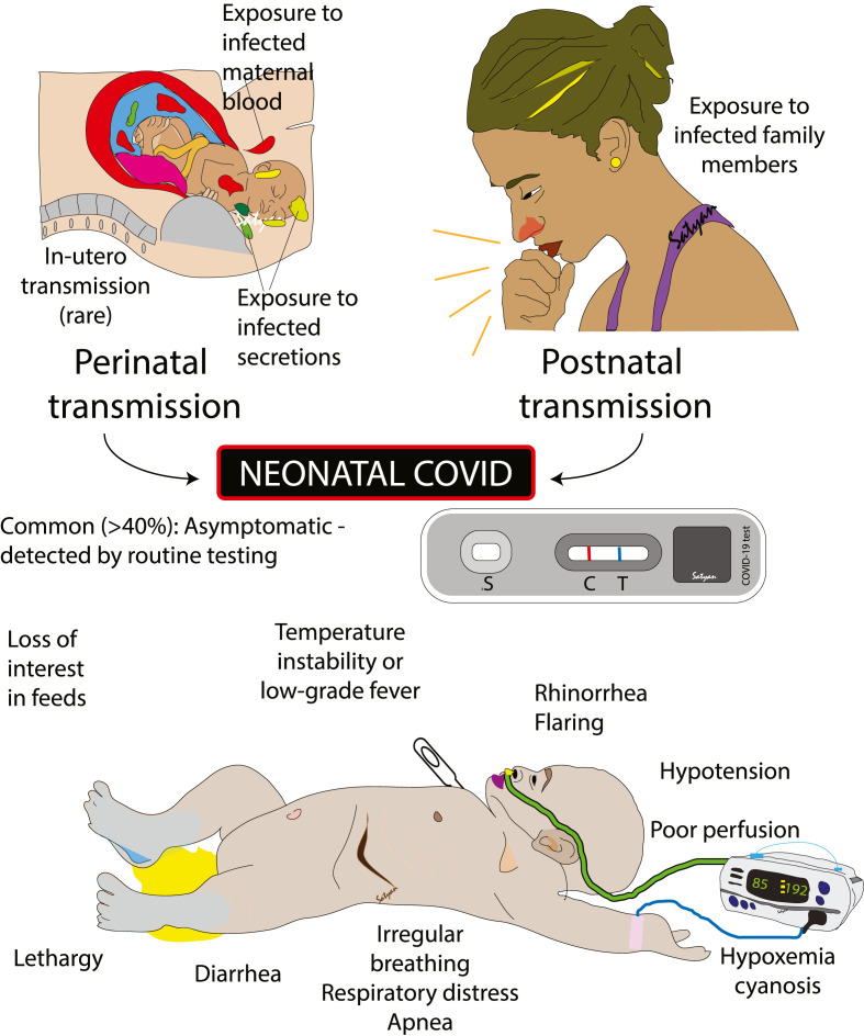 Clinical features of neonatal COVID-19