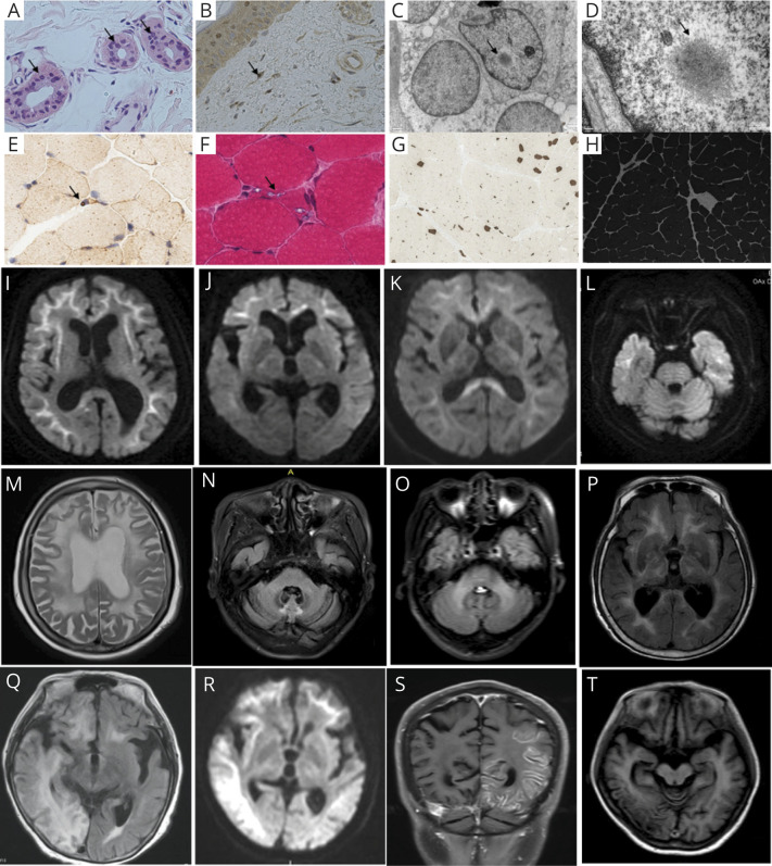 Clinical Features and Classification of Neuronal Intranuclear Inclusion Disease.