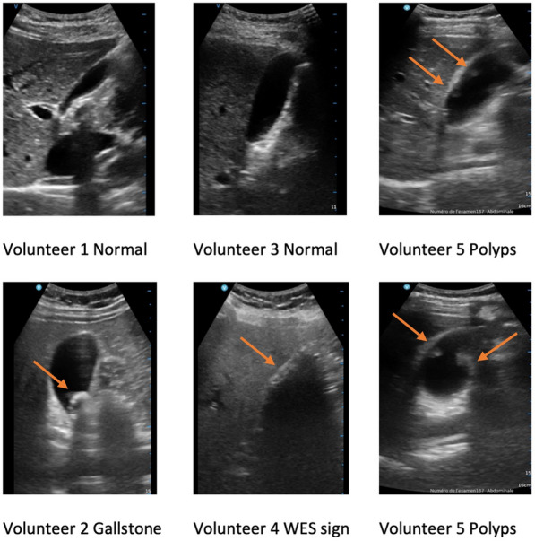 Is gallbladder PoCUS diagnostic accuracy accessible to medical students after PoCUS training exclusively on healthy volunteers? A pilot randomized control trial.