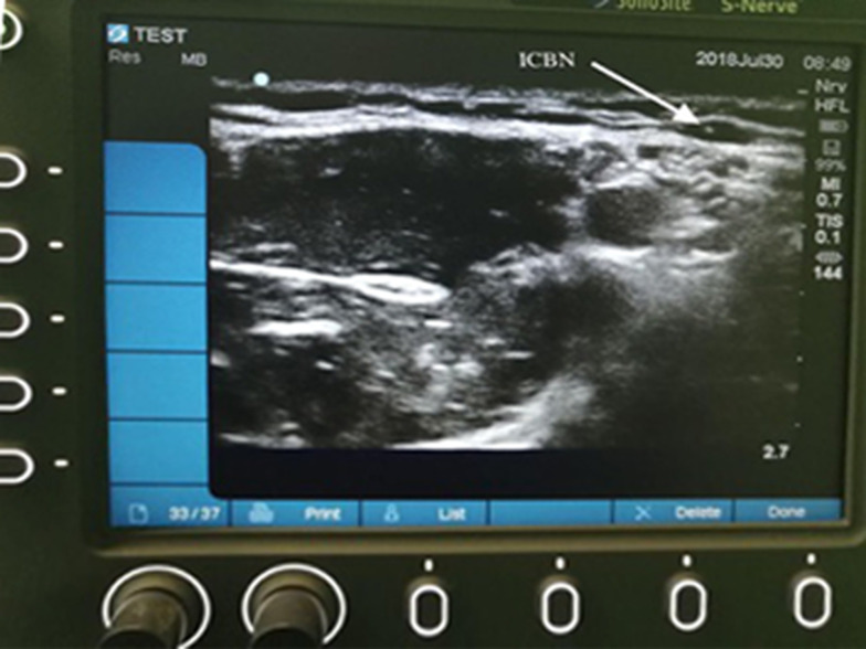 Comparison of the Effect of Intercostobrachial Nerve Block with and Without Ultrasound Guidance on Tourniquet Pain After Axillary Block of Brachial Plexus: A Randomized Clinical Trial.