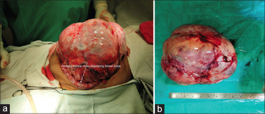 A rare case of primary retroperitoneal extraovarian granulosa cell tumor.