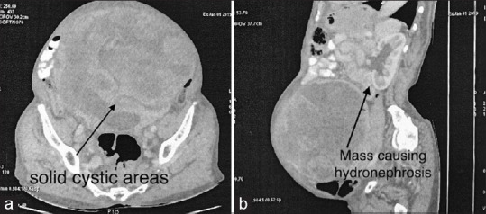 A rare case of primary retroperitoneal extraovarian granulosa cell tumor.