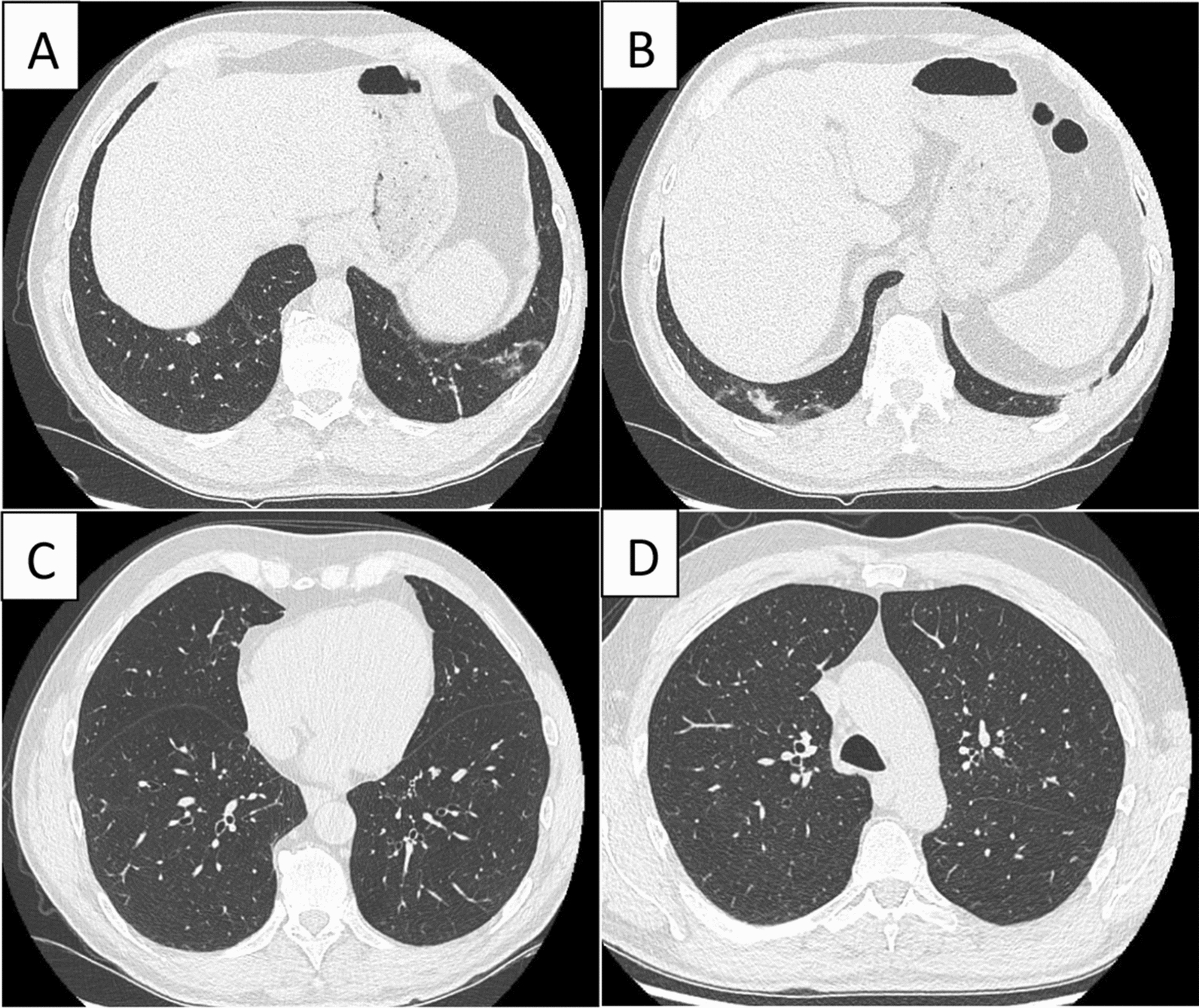 Several Nocardia abcessus bronchiolitis in a patient treated with inhaled corticosteroids: a case report.