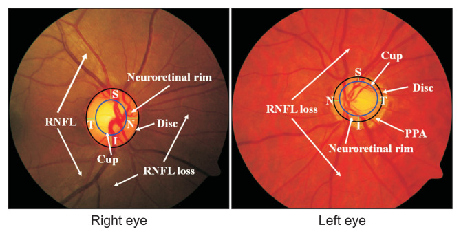 Automatic Method for Optic Disc Segmentation Using Deep Learning on Retinal Fundus Images.