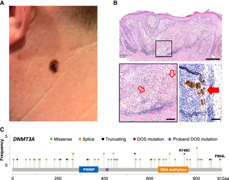 Melanoma in a patient with DNMT3A overgrowth syndrome.