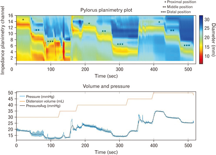 Pyloric Functional Lumen Imaging Probe Measurements Are Dependent on Balloon Position.