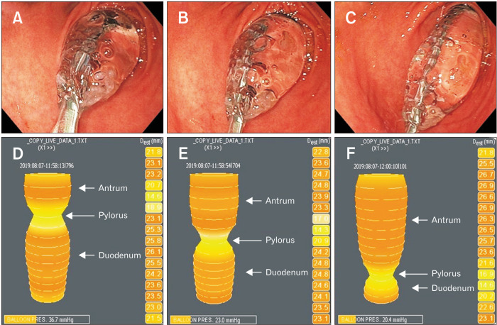 Pyloric Functional Lumen Imaging Probe Measurements Are Dependent on Balloon Position.