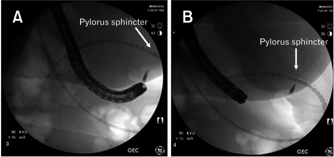 Pyloric Functional Lumen Imaging Probe Measurements Are Dependent on Balloon Position.