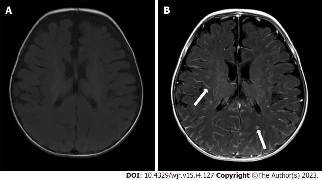 Does sevoflurane sedation in pediatric patients lead to "pseudo" leptomeningeal enhancement in the brain on 3 Tesla magnetic resonance imaging?