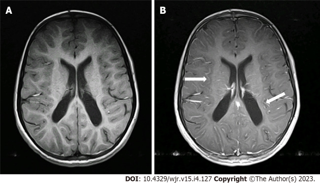 Does sevoflurane sedation in pediatric patients lead to "pseudo" leptomeningeal enhancement in the brain on 3 Tesla magnetic resonance imaging?