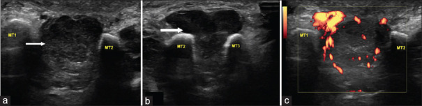 Soft-Tissue Mass Lesion of the Foot - Synovial Sarcoma.