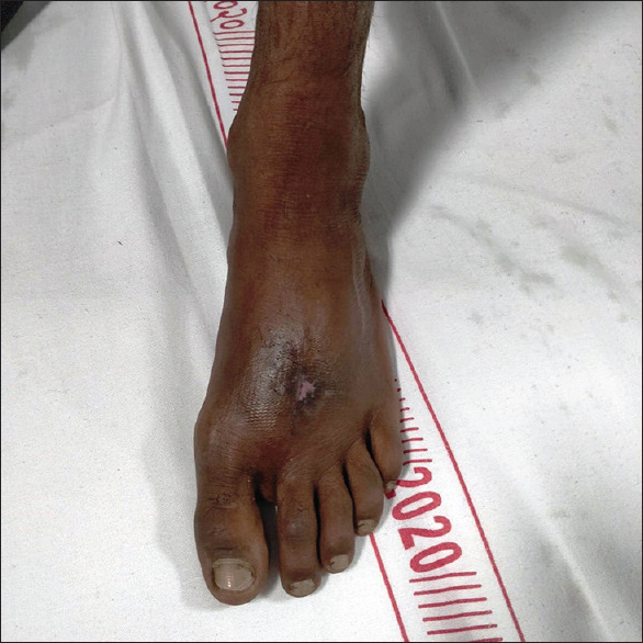 Soft-Tissue Mass Lesion of the Foot - Synovial Sarcoma.