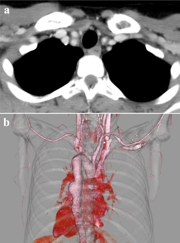 Tocilizumab Treatment for Takayasu Arteritis in Pregnancy: A Case Report With Positive Maternal and Neonatal Outcomes.