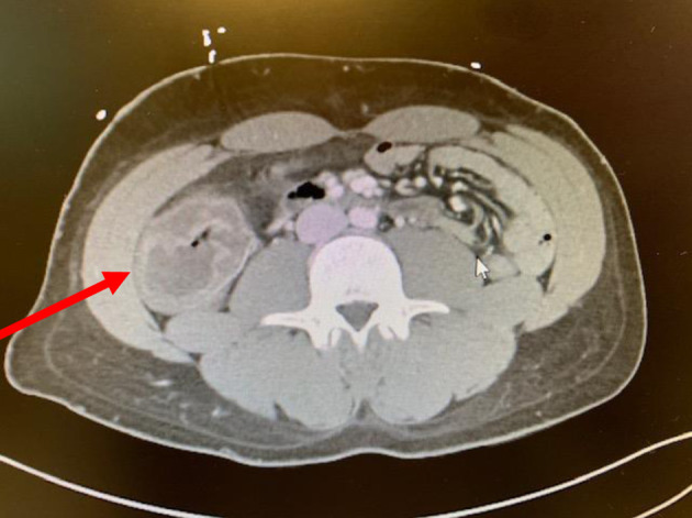 Neutropenic Enterocolitis: An Uncommon, but Fearsome Complication of Leukemia.