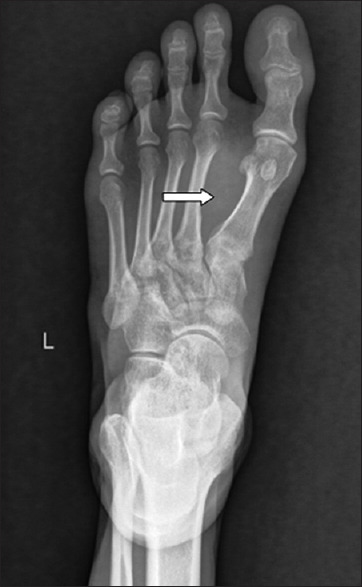 Soft-Tissue Mass Lesion of the Foot - Synovial Sarcoma.