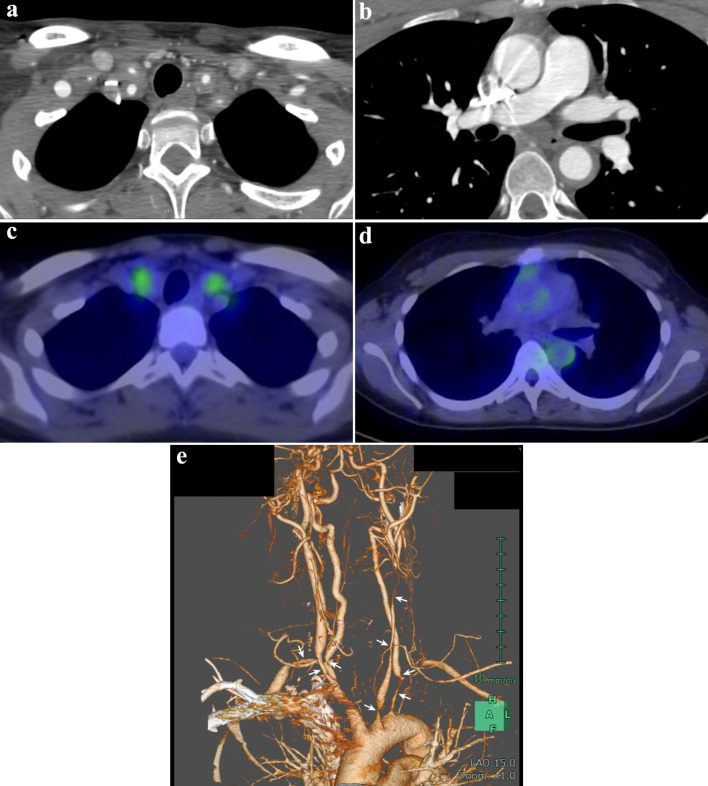 Tocilizumab Treatment for Takayasu Arteritis in Pregnancy: A Case Report With Positive Maternal and Neonatal Outcomes.