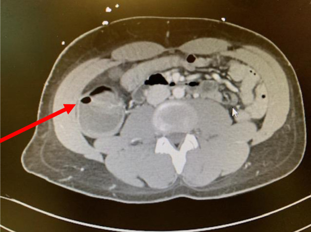 Neutropenic Enterocolitis: An Uncommon, but Fearsome Complication of Leukemia.