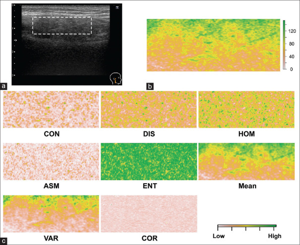 Quantitative Texture Analysis of Parotid Gland Ultrasound Images Yield Higher Correlation with Scintigraphy than Semiquantitative Scoring in Primary Sjögren's Syndrome Patients.