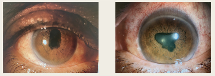 Ocular side effects of Trametinib and Dabrafenib: a case report.