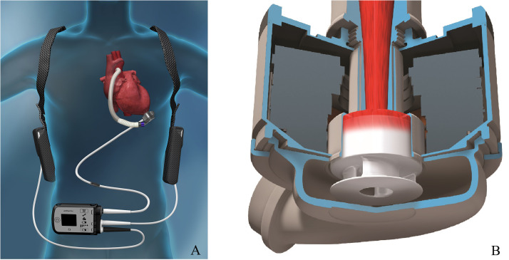 Long-term assist device patients admitted to ICU: Tips and pitfalls