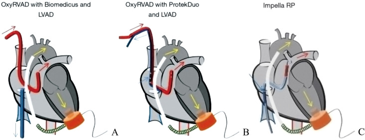 Long-term assist device patients admitted to ICU: Tips and pitfalls