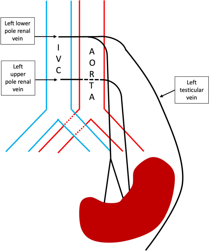 Oh nuts, they've got a pelvic kidney - a tricky testicular vein embolisation.