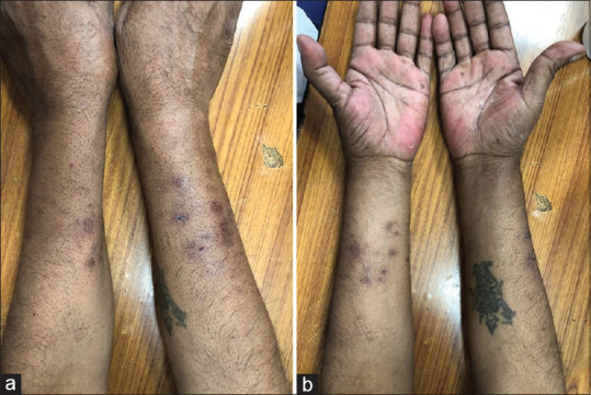 Bullous hemorrhagic dermatosis: A rare cutaneous reaction of heparin.