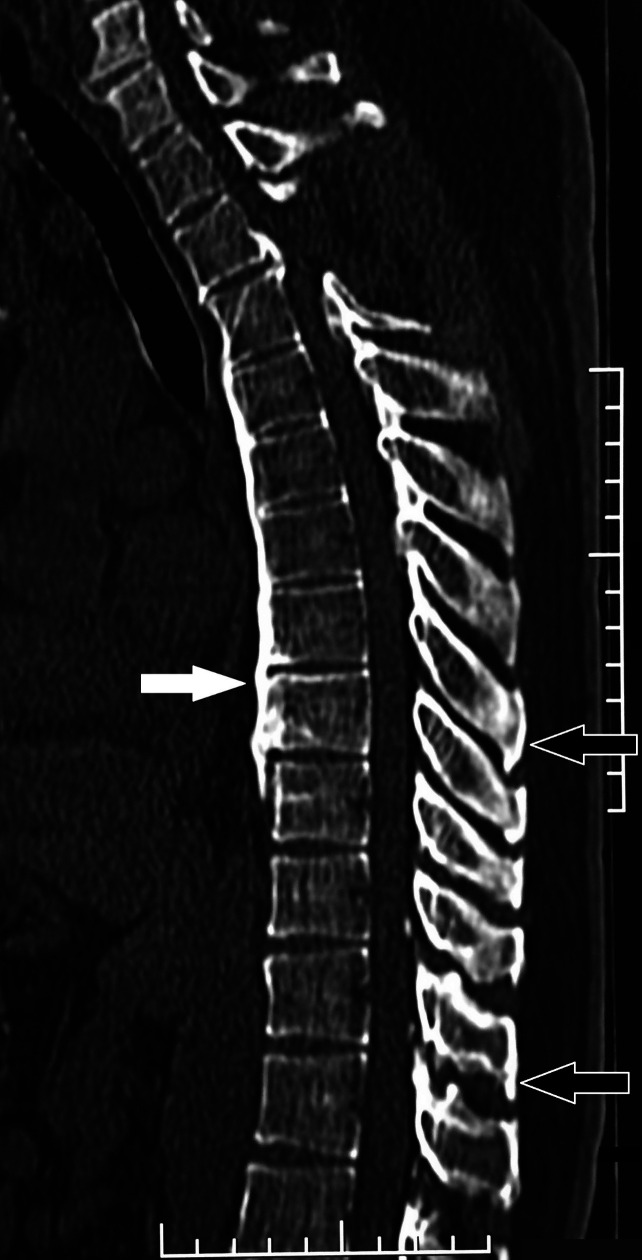 Diffuse Idiopathic Skeletal Hyperostosis in a Young Male.