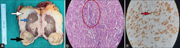 Primary retroperitoneal fibrosis presenting as a renal mass.