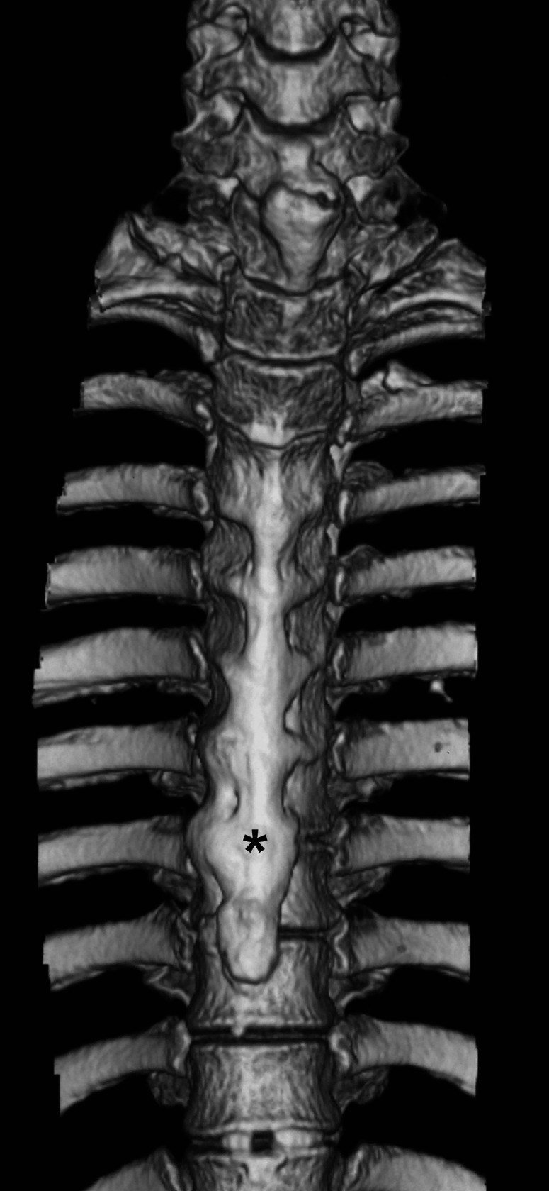 Diffuse Idiopathic Skeletal Hyperostosis in a Young Male.