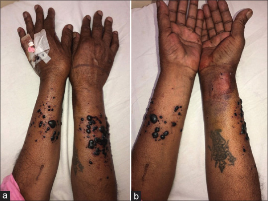 Bullous hemorrhagic dermatosis: A rare cutaneous reaction of heparin.