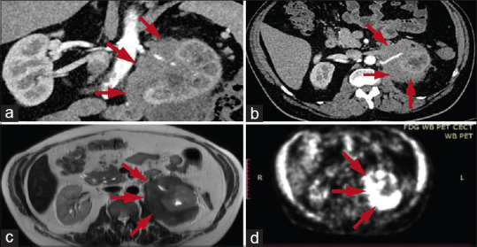 Primary retroperitoneal fibrosis presenting as a renal mass.