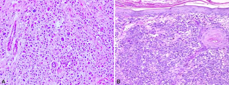 Morphological aspects and therapeutic options in melanoma: a narrative review of the past decade.