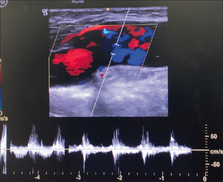 Pulsatile bleeding varicose veins due to tricuspid regurgitation successfully treated with foam sclerotherapy.