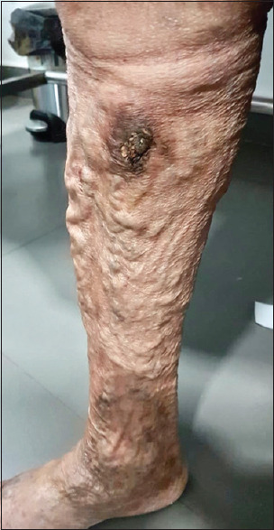 Pulsatile bleeding varicose veins due to tricuspid regurgitation successfully treated with foam sclerotherapy.