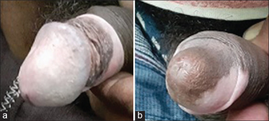 Comparative effect of intraurethral clobetasol and tacrolimus in lichen sclerosus-associated urethral stricture disease.