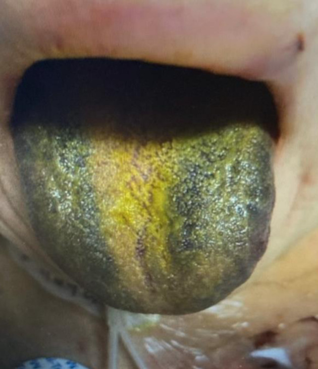 Rare Case of Tongue Ischemia Following Cardiopulmonary Bypass.