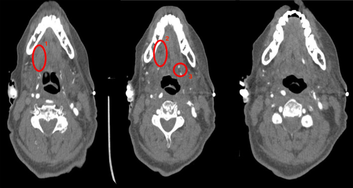 Rare Case of Tongue Ischemia Following Cardiopulmonary Bypass.