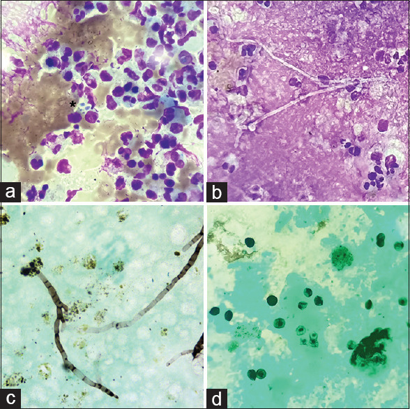 Bronchoalveolar Lavage in Diagnostic Evaluation of Pulmonary Diseases- An Institutional Experience.