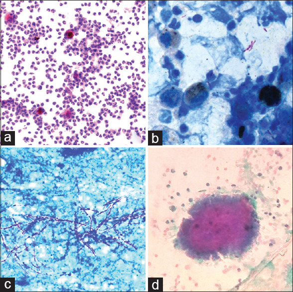 Bronchoalveolar Lavage in Diagnostic Evaluation of Pulmonary Diseases- An Institutional Experience.