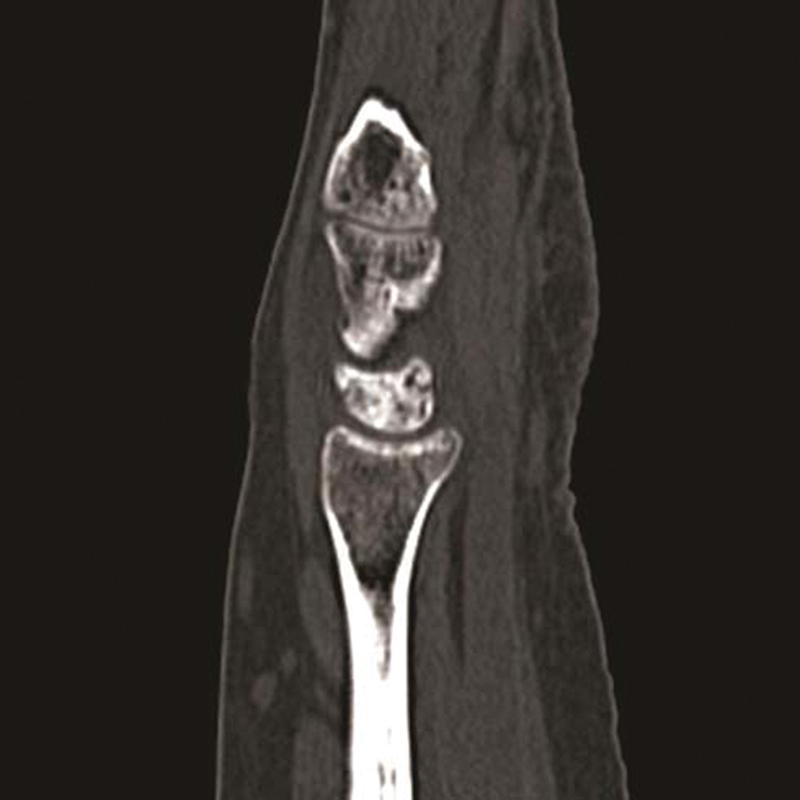 Matching Kienböck's Treatment Options to Specific Features of Each Case.