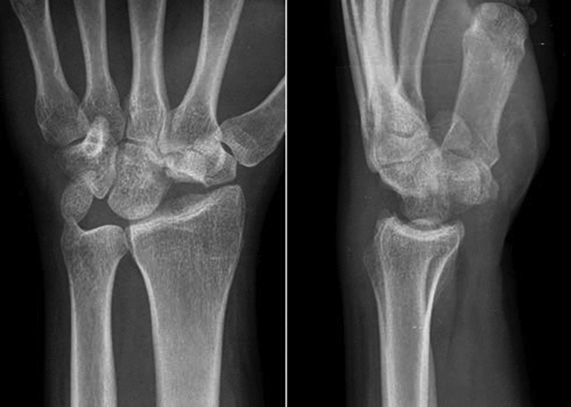 Matching Kienböck's Treatment Options to Specific Features of Each Case.