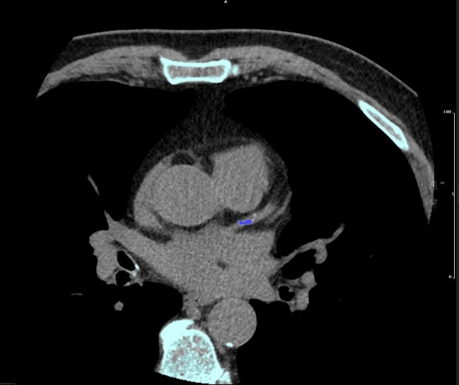 Correlation between Coronary Artery Disease and Non-Alcoholic Fatty Liver Disease Using Computed Tomography Coronary Calcium Scans.