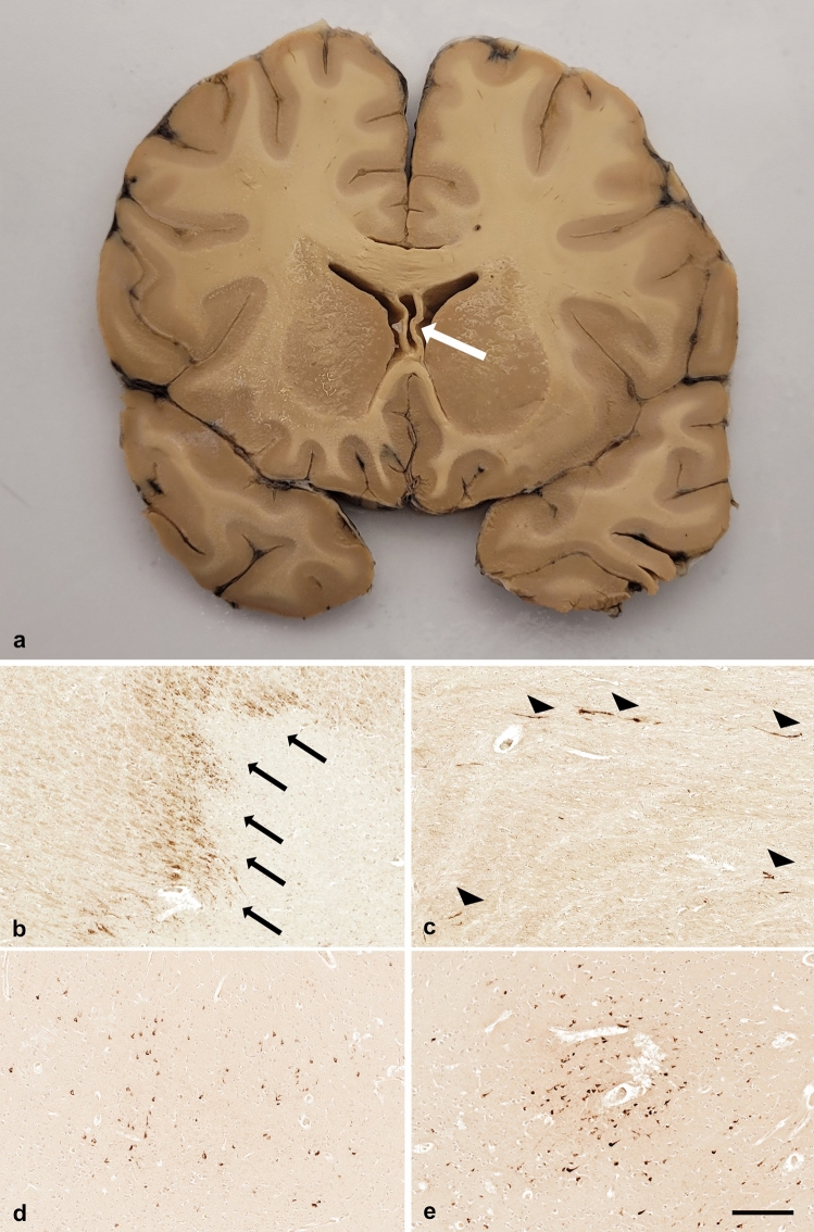 The perils of contact sport: pathologies of diffuse brain swelling and chronic traumatic encephalopathy neuropathologic change in a 23-year-old rugby union player