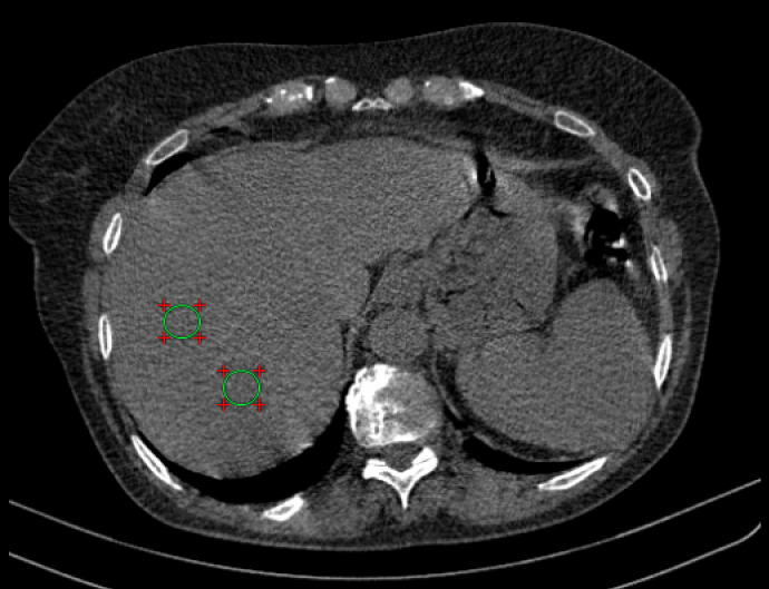 Correlation between Coronary Artery Disease and Non-Alcoholic Fatty Liver Disease Using Computed Tomography Coronary Calcium Scans.