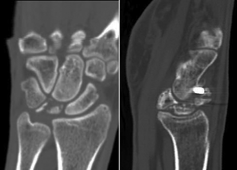 Matching Kienböck's Treatment Options to Specific Features of Each Case.