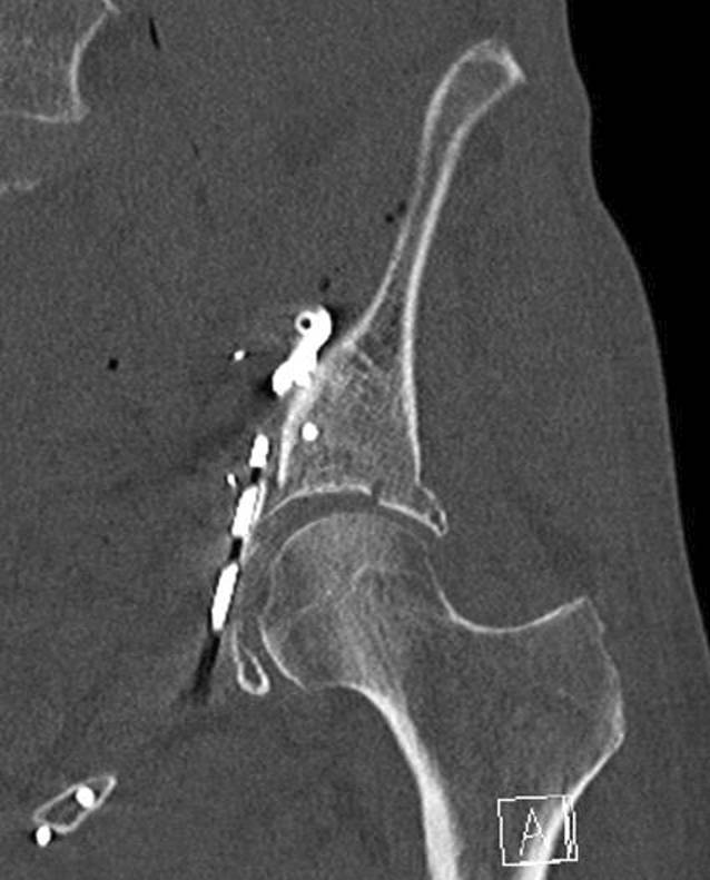 [The pararectus approach: surgical procedure for acetabular fractures].